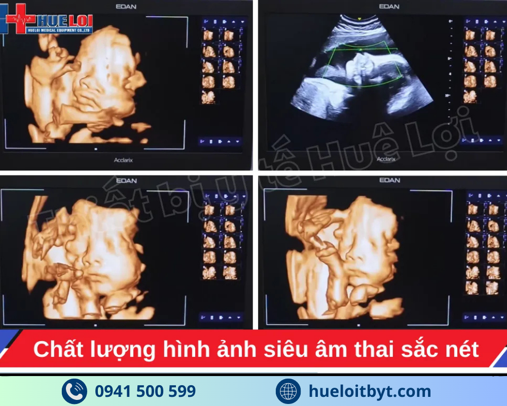 MÁY SIÊU ÂM CHẨN ĐOÁN CAO CẤP EDAN ACCLARIX LX85