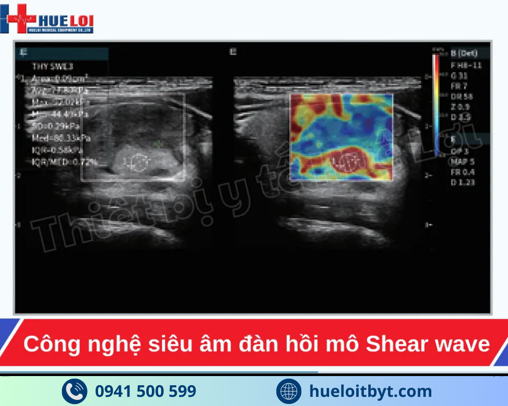 MÁY SIÊU ÂM CHẨN ĐOÁN CAO CẤP EDAN ACCLARIX LX85