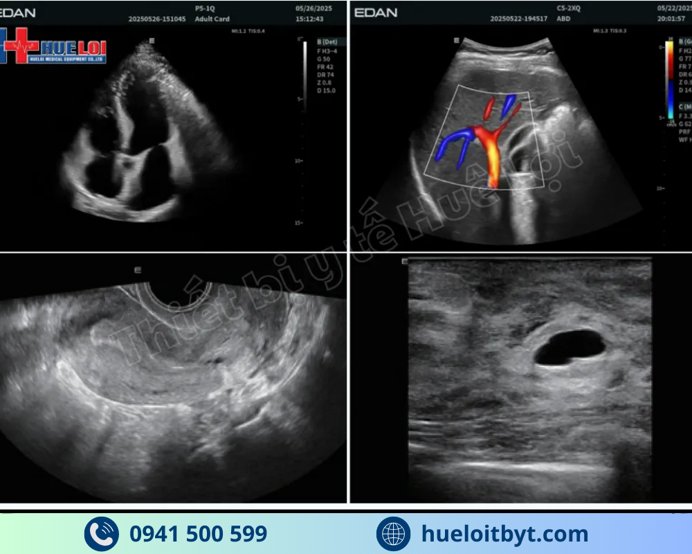 MÁY SIÊU ÂM CHẨN ĐOÁN CAO CẤP EDAN ACCLARIX LX85