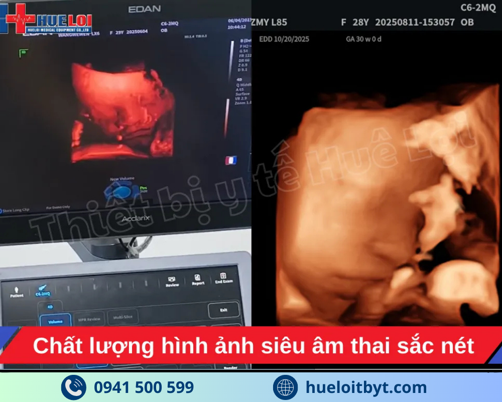 MÁY SIÊU ÂM CHẨN ĐOÁN CAO CẤP EDAN ACCLARIX LX85