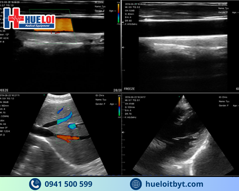 MÁY SIÊU ÂM CẦM TAY KHÔNG DÂY 3 ĐẦU DÒ