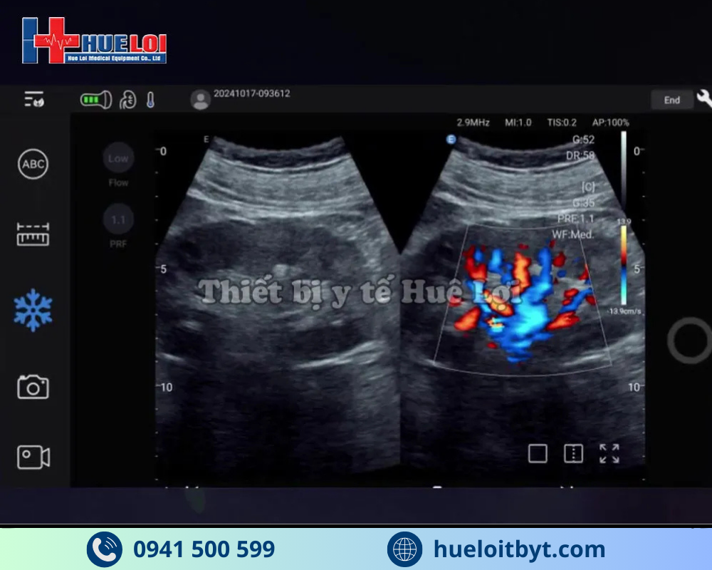 MÁY SIÊU ÂM CẦM TAY EDAN NANO C5 EXP HIỆN ĐẠI