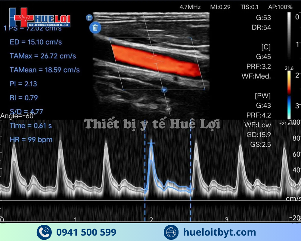 MÁY SIÊU ÂM CẦM TAY EDAN NANO L12 EXP VỚI CÁC CÔNG NGHỆ HIỆN ĐẠI