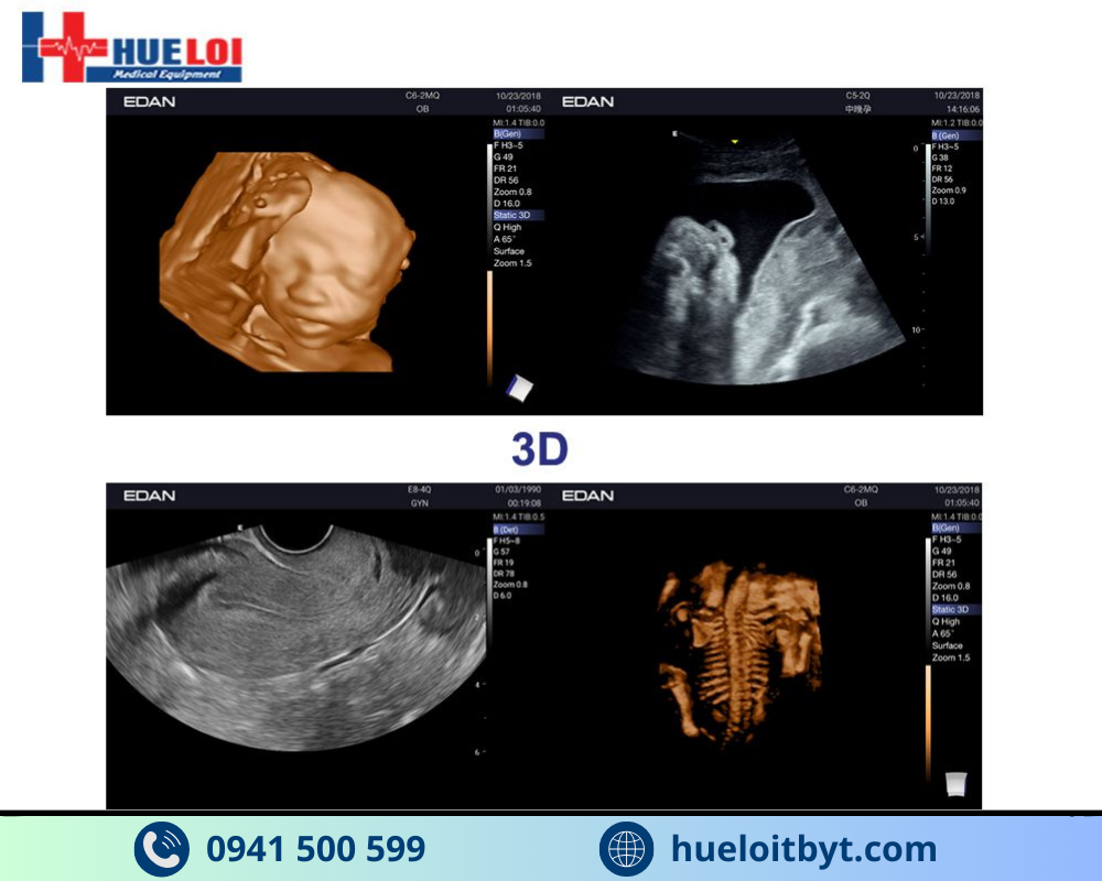 MÁY SIÊU ÂM HÌNH ẢNH EDAN AX3 CAO CẤP