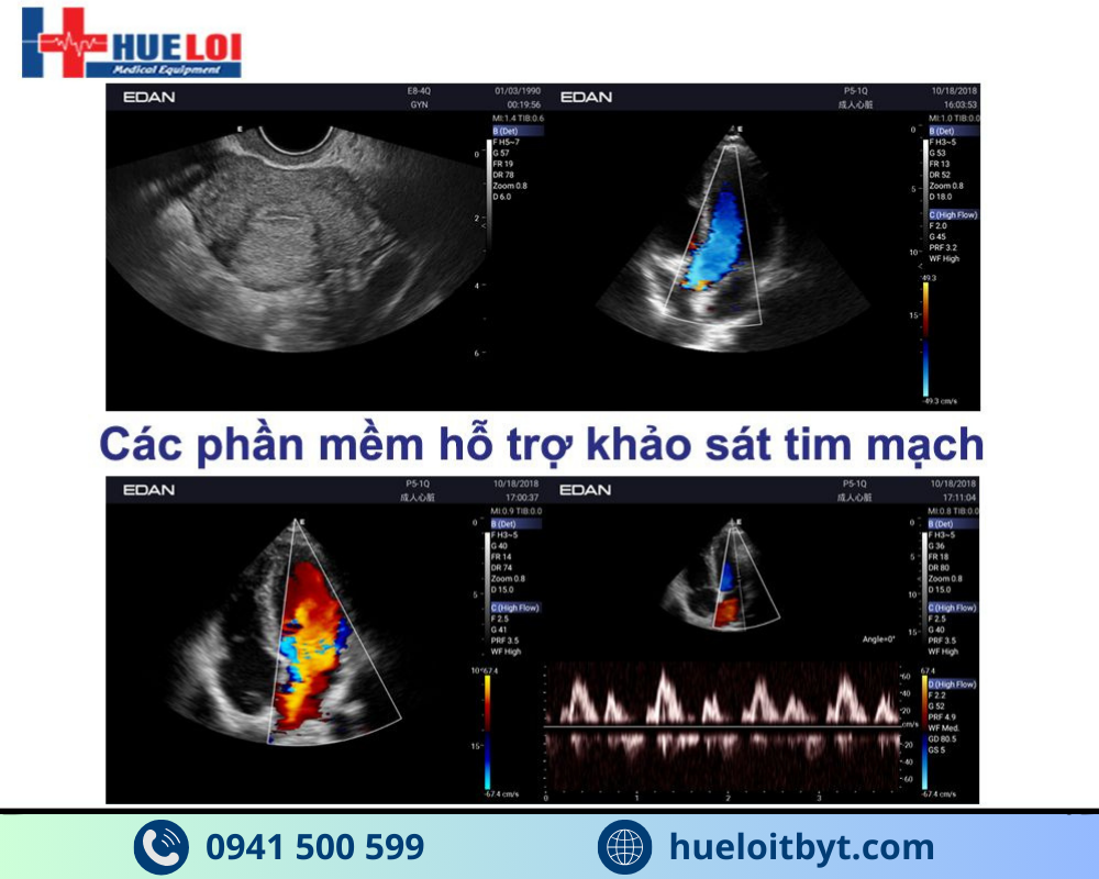 MÁY SIÊU ÂM HÌNH ẢNH EDAN AX3 CAO CẤP