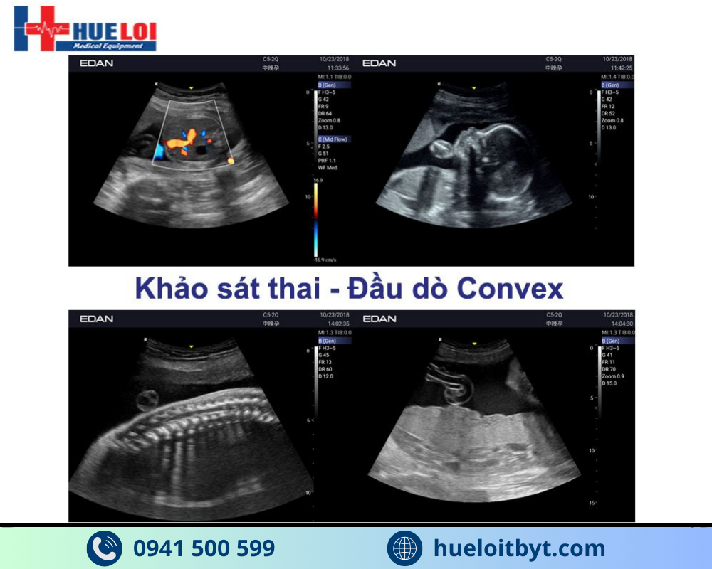 MÁY SIÊU ÂM HÌNH ẢNH EDAN AX3 CAO CẤP