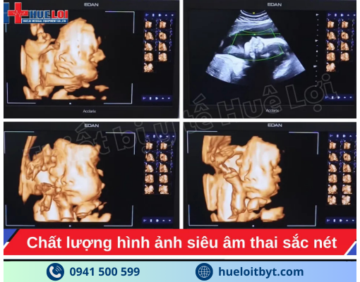 MÁY SIÊU ÂM CHẨN ĐOÁN CAO CẤP EDAN ACCLARIX LX85