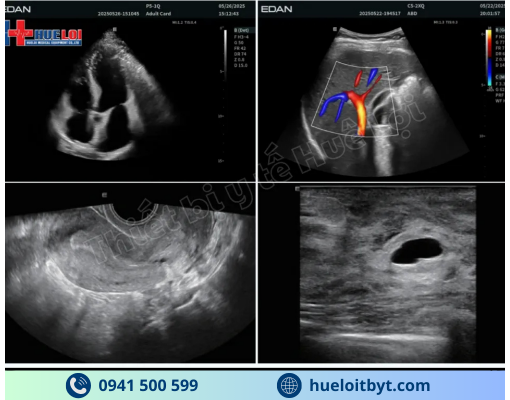MÁY SIÊU ÂM CHẨN ĐOÁN CAO CẤP EDAN ACCLARIX LX85
