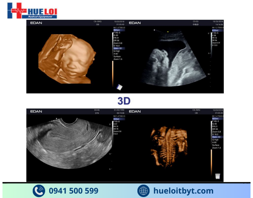 MÁY SIÊU ÂM HÌNH ẢNH EDAN AX3 CAO CẤP
