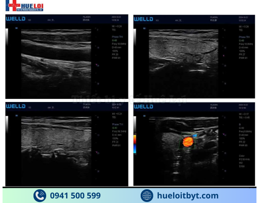 MÁY SIÊU ÂM XÁCH TAY CẢM ỨNG 2 ĐẦU DÒ P10