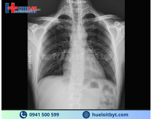 HỆ THỐNG X-QUANG KỸ THUẬT SỐ CỐ ĐỊNH YOLONG