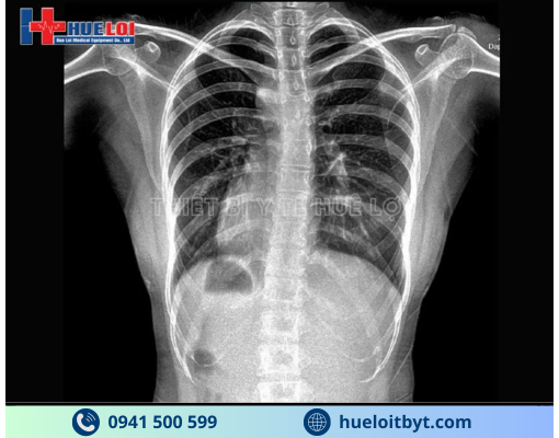 HỆ THỐNG X-QUANG KỸ THUẬT SỐ CỐ ĐỊNH YOLONG