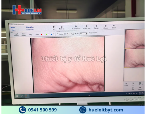 MÁY SOI CỔ TỬ CUNG FULL HD SW-304 GIÁ RẺ