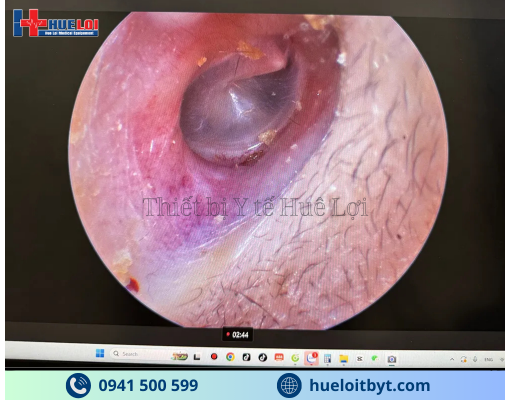 MÁY NỘI SOI TAI MŨI HỌNG MINI FULL HD GIÁ RẺ