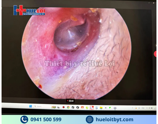 MÁY NỘI SOI TAI MŨI HỌNG MINI FULL HD GIÁ RẺ